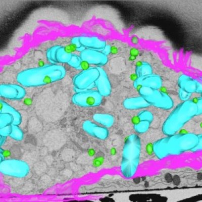 3D electron microscopy of macrophage infected by bacteria (blue) showing lipid droplets (green) and the cell surface (pink).